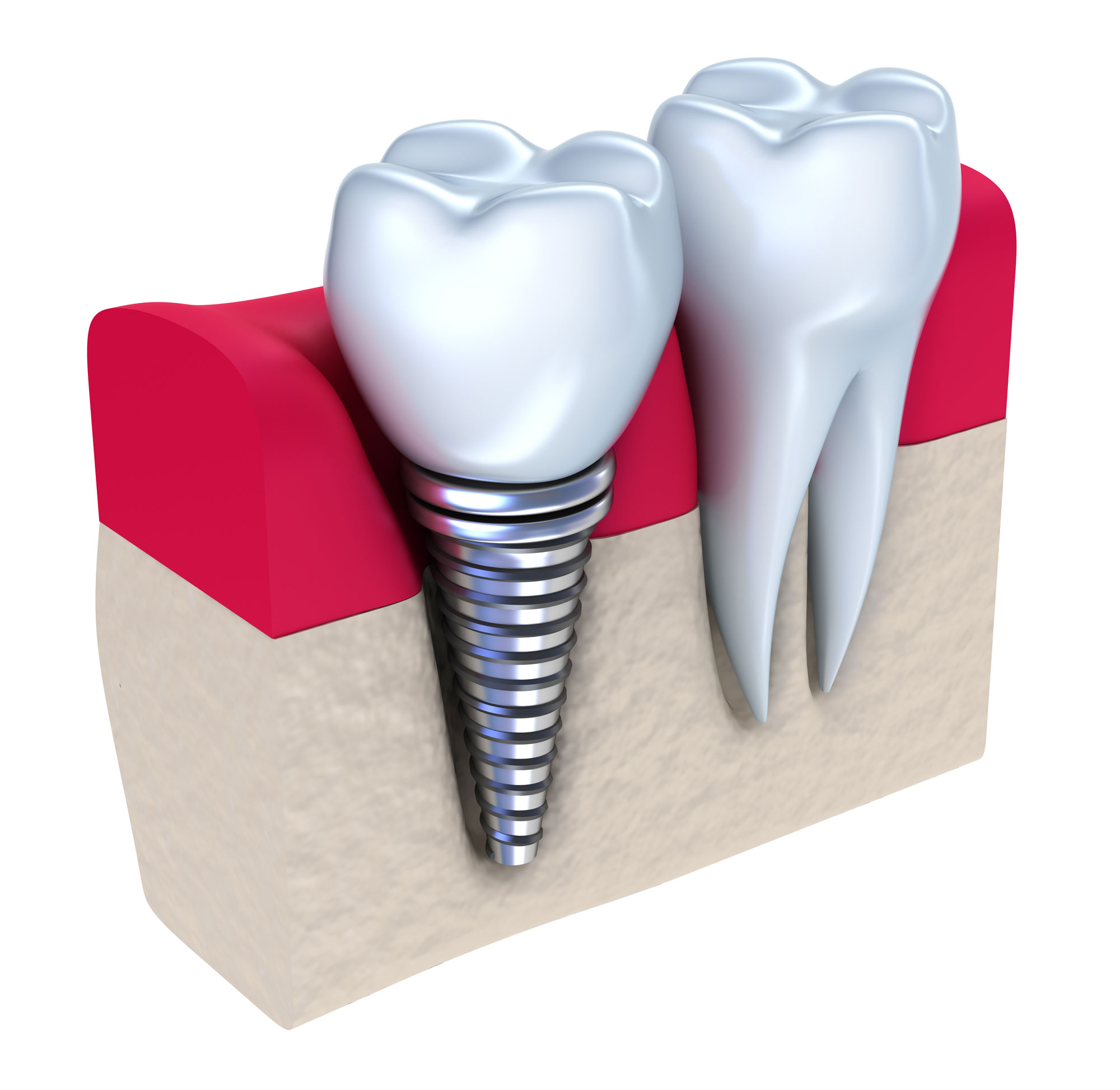 Tooth replacement by an implant in case of one tooth missing.