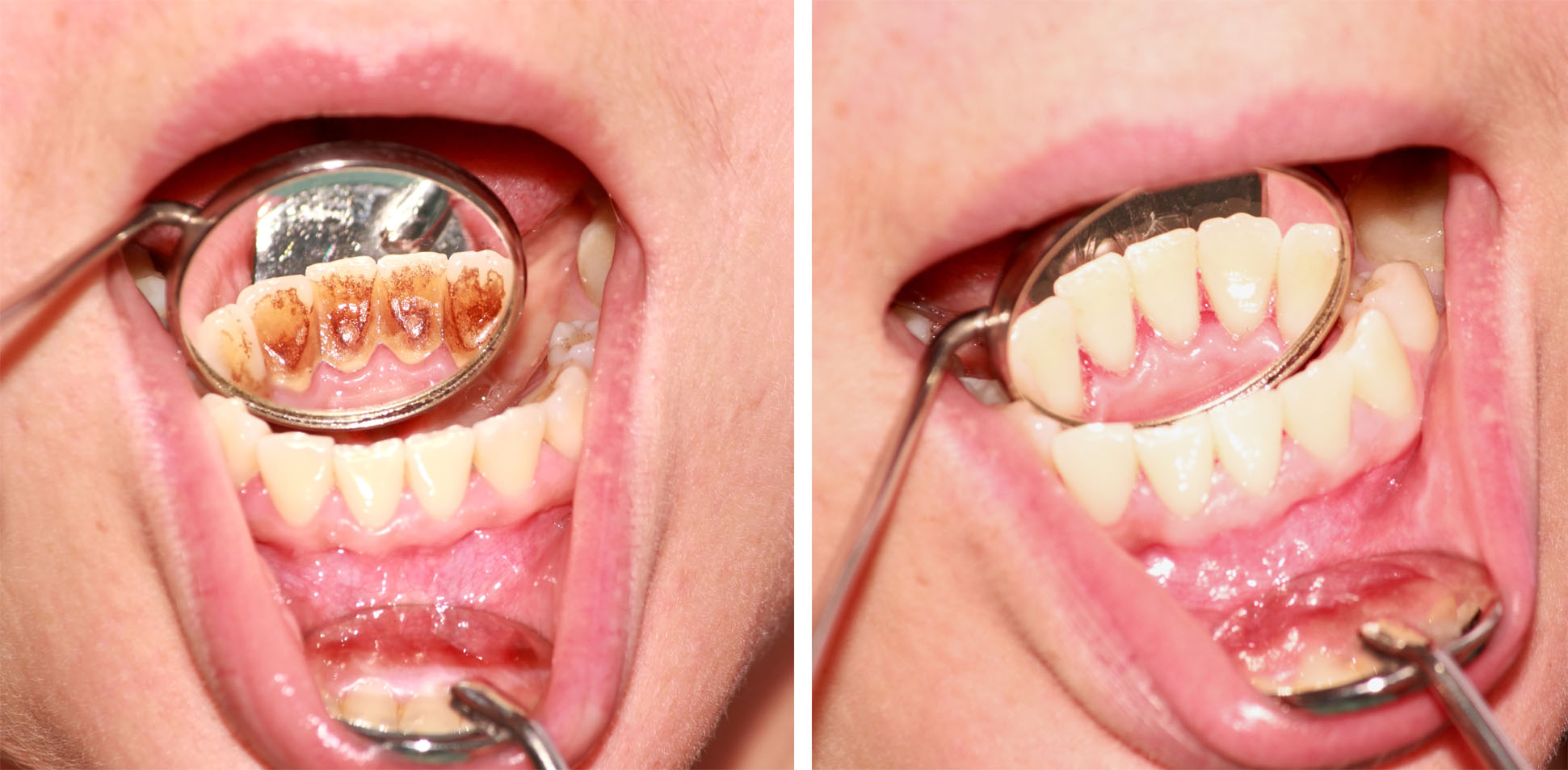 The process of tartar removal (before, after, photo)