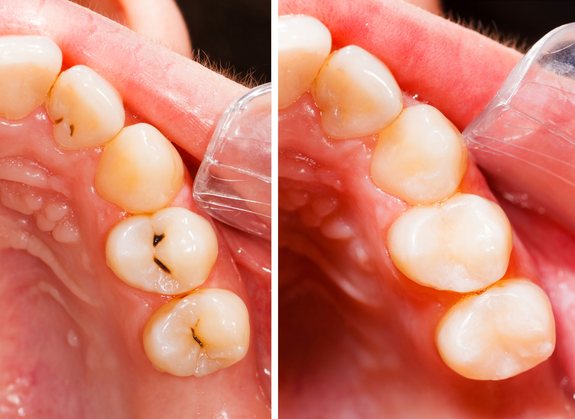 Before and after a treatment for filling.
