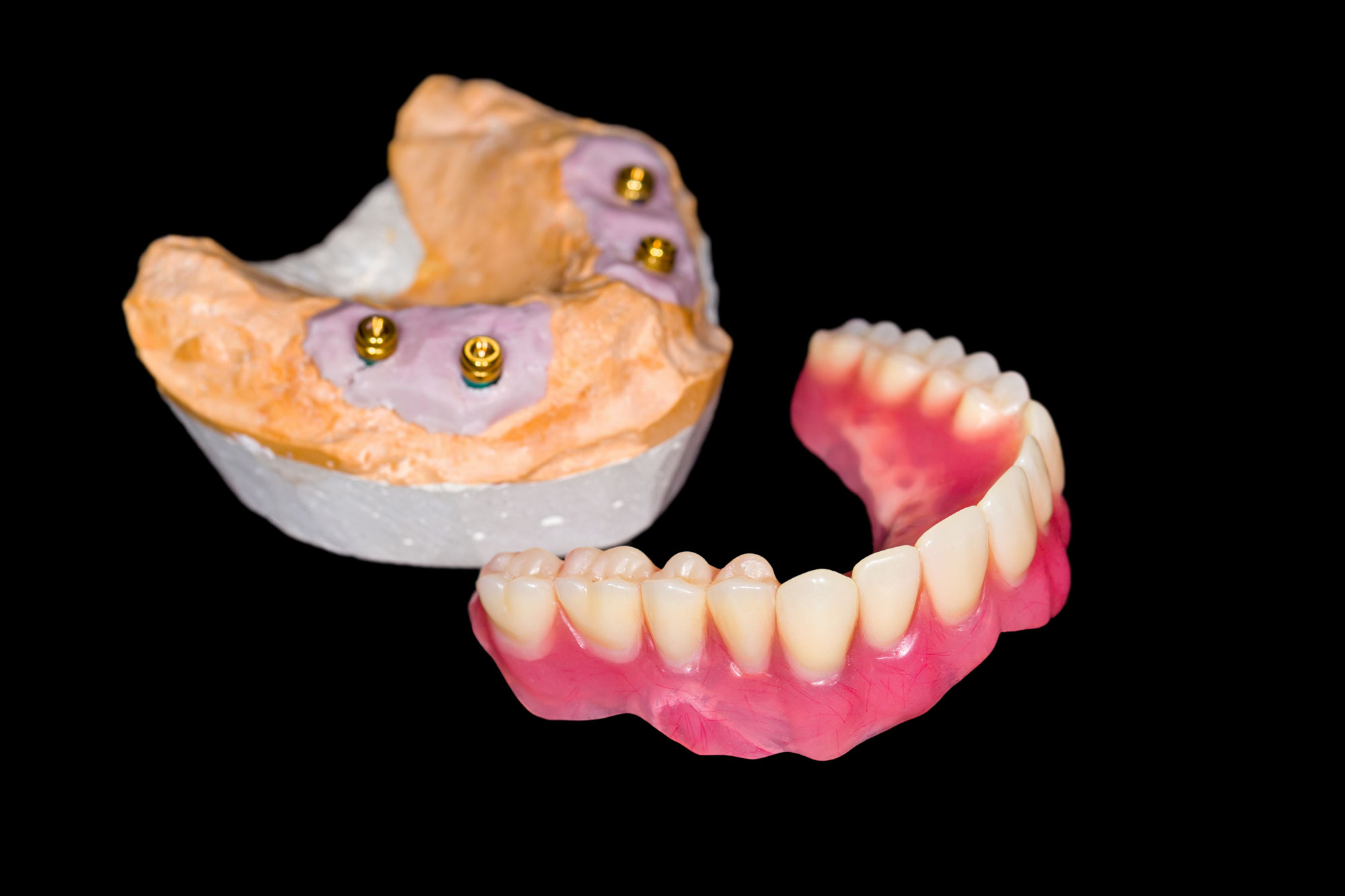 Removable full-row implant in case of total loss of teeth