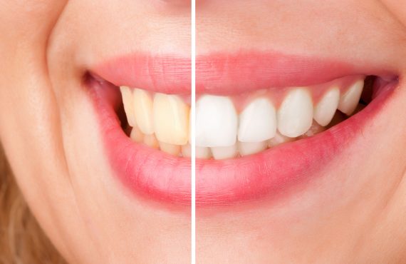 A woman’s smile before and after tooth whitening.