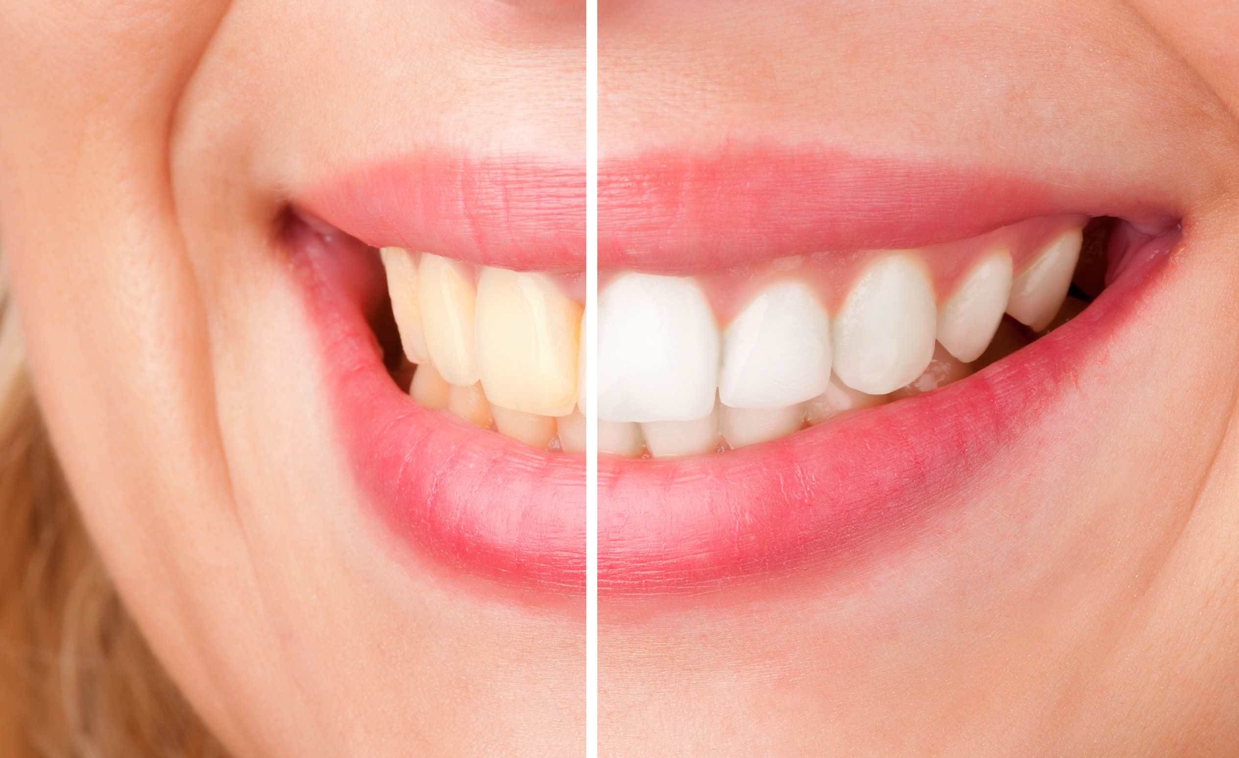 A woman’s smile before and after tooth whitening.