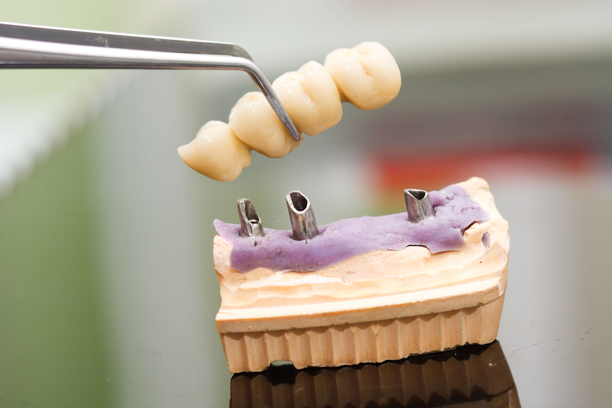 Tooth replacement by an implant in case of teeth missing at the end of the row.